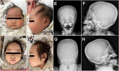 Trio-Based Whole-Exome Sequencing Identifies a De novo EFNB1 Mutation as a Genetic Cause in Female Infant With Brain Anomaly and Developmental Delay